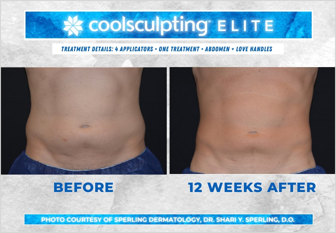 Before & After Abdomen CoolSculpting in New Jersey