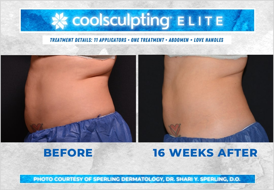 Before & After Abdomen CoolSculpting in New Jersey