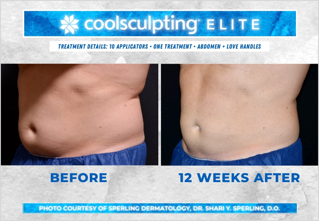 Before & After Abdomen CoolSculpting in New Jersey