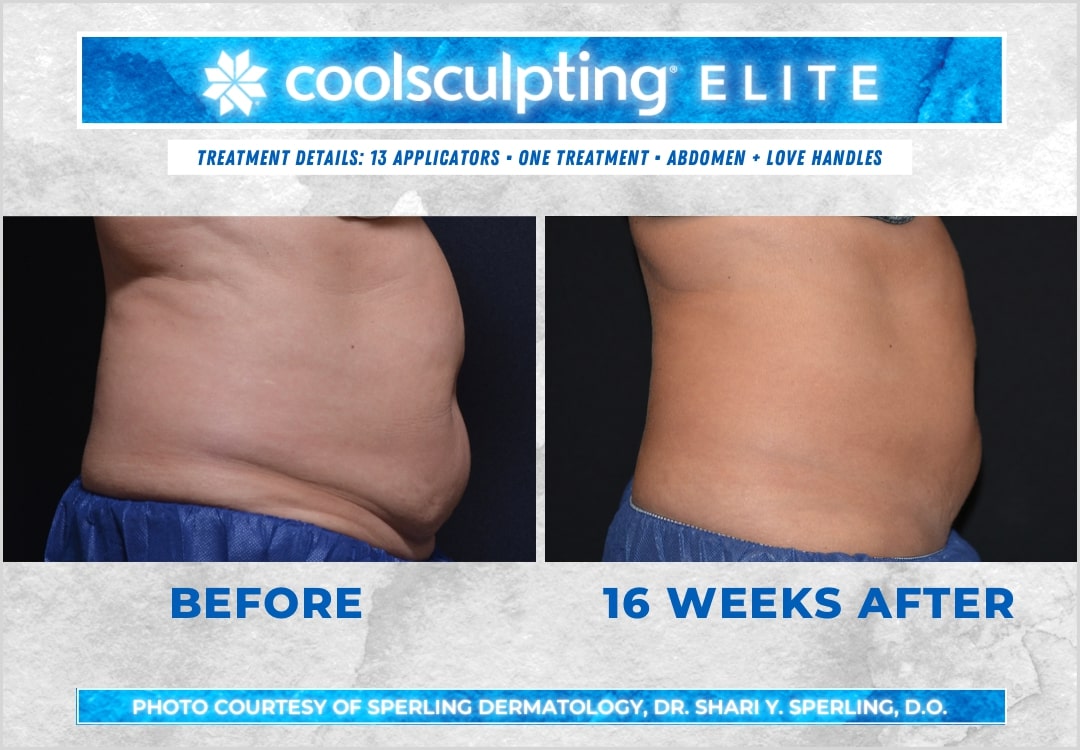 Before & After Abdomen CoolSculpting in New Jersey