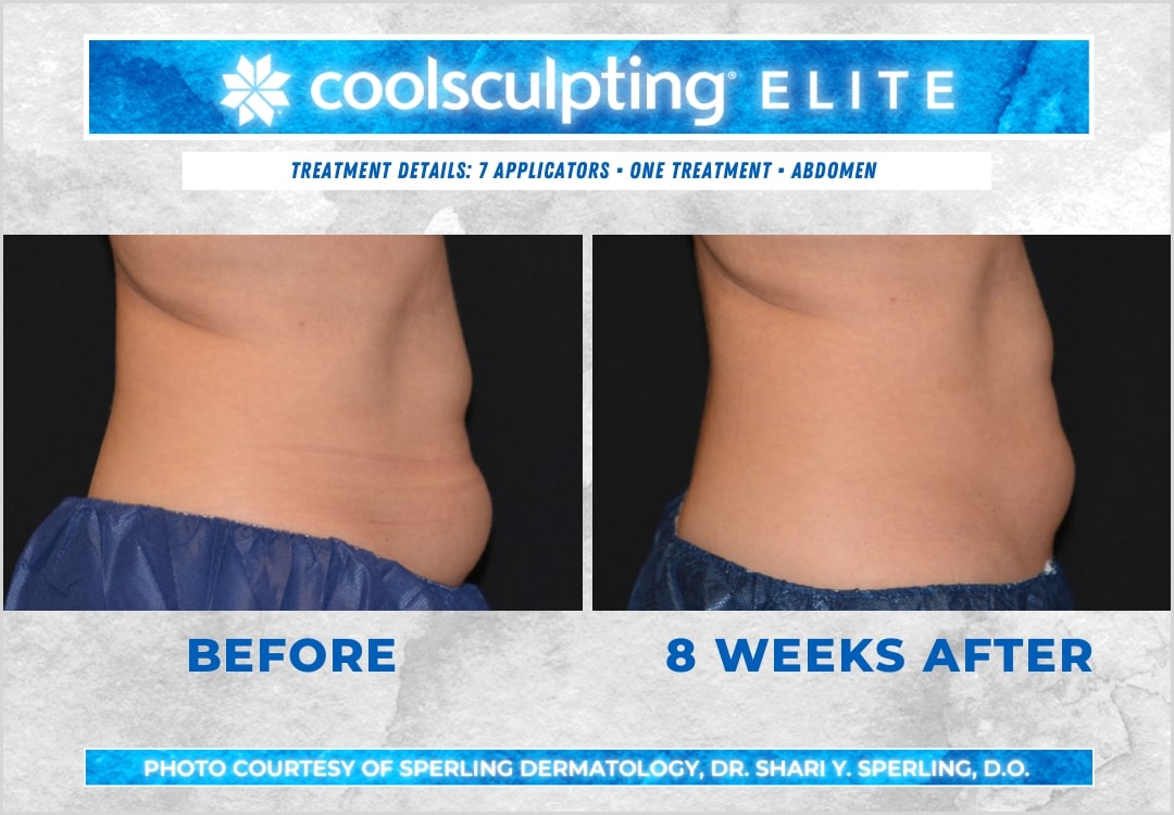 Before & After Abdomen CoolSculpting in New Jersey