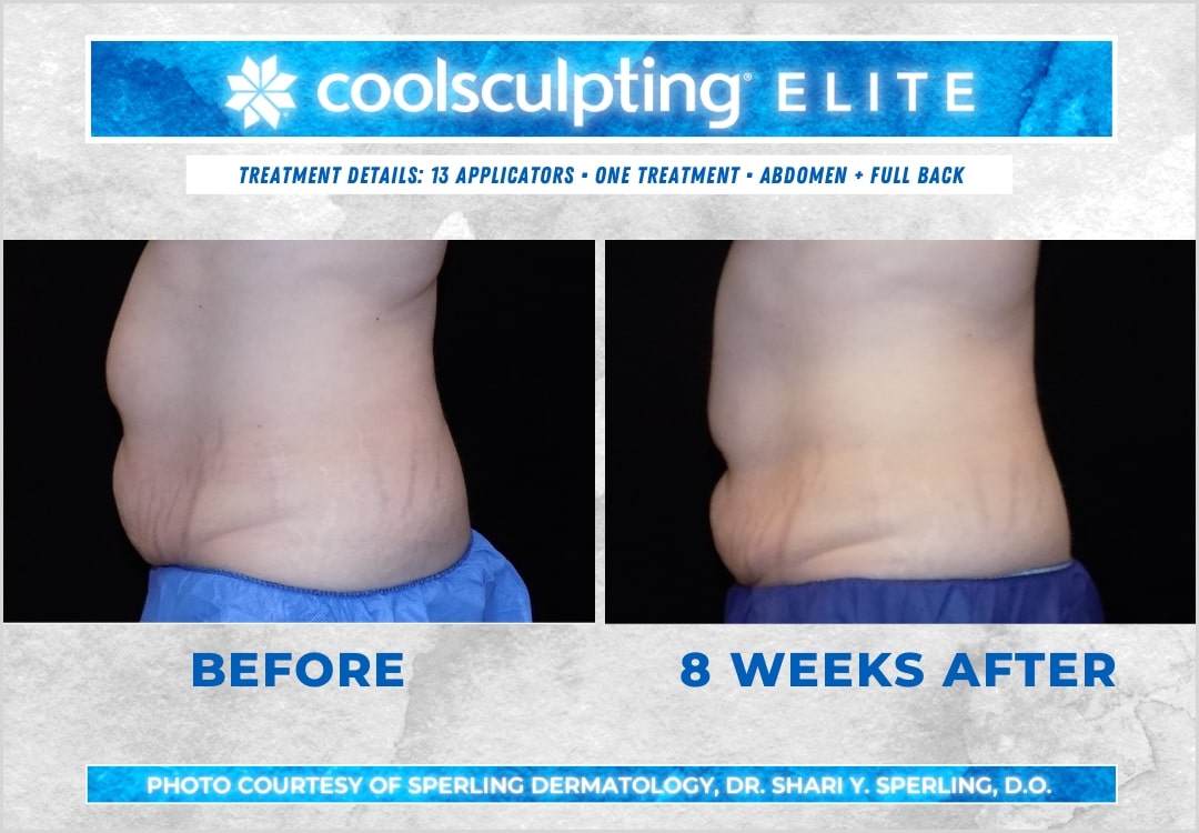 Before & After Abdomen CoolSculpting in New Jersey