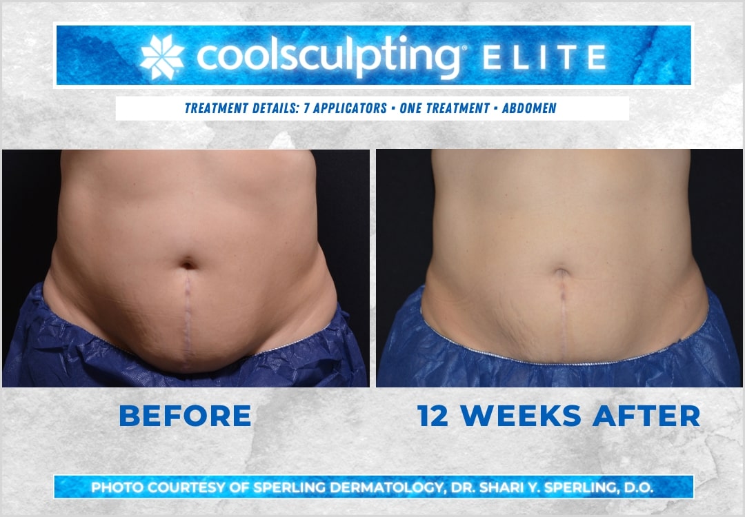 Before & After Abdomen CoolSculpting in New Jersey