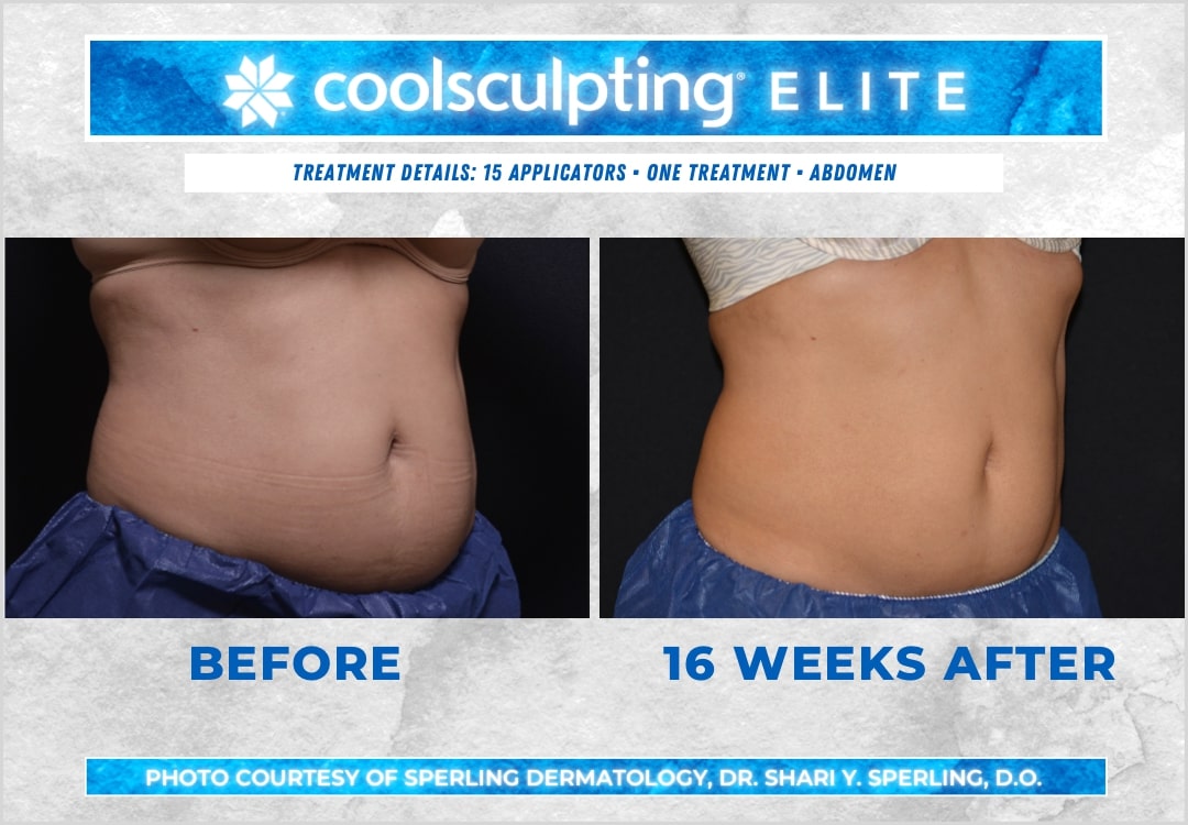 Before & After Abdomen CoolSculpting in New Jersey