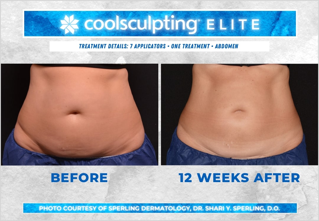 Before & After Abdomen CoolSculpting in New Jersey