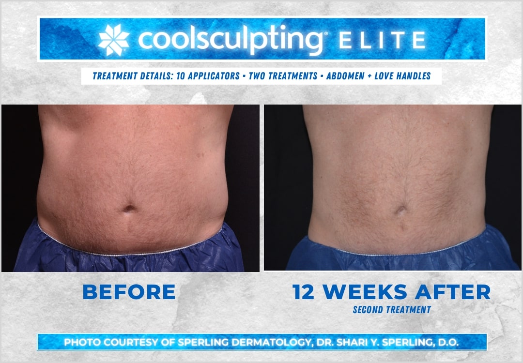 Before & After Abdomen CoolSculpting in New Jersey