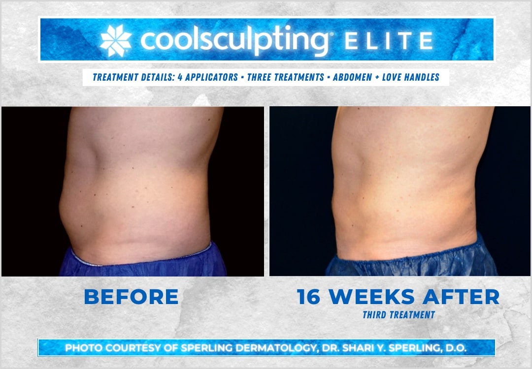 Before & After Abdomen CoolSculpting in New Jersey