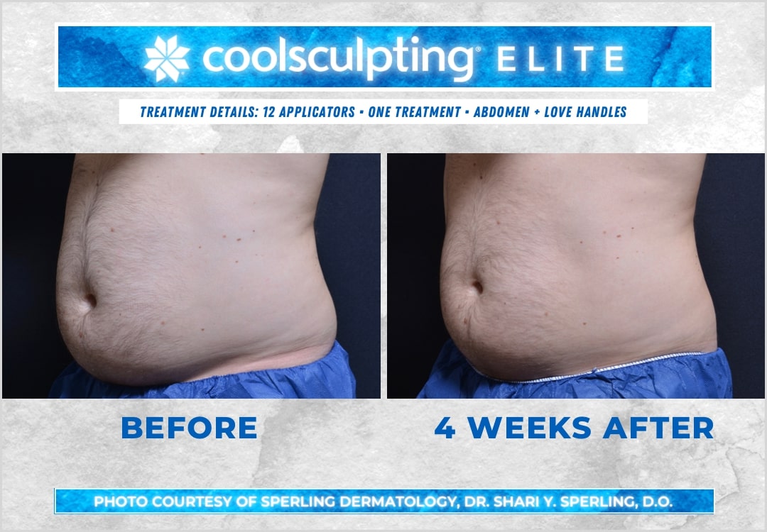 Before & After Abdomen CoolSculpting in New Jersey