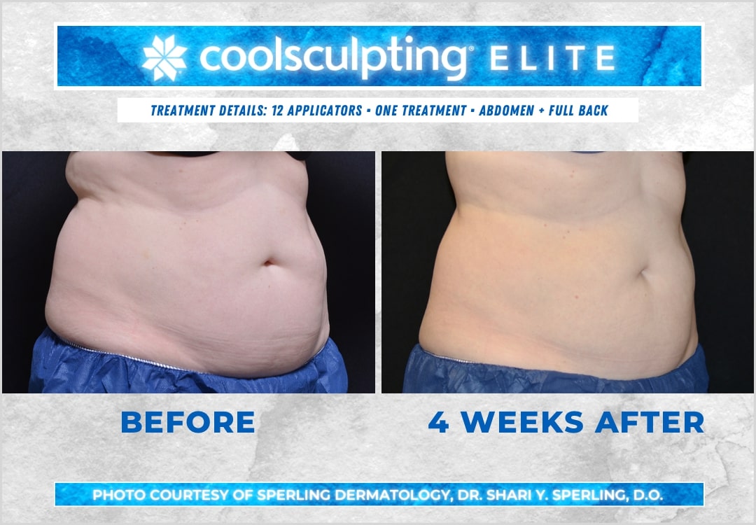 Before & After Abdomen CoolSculpting in New Jersey