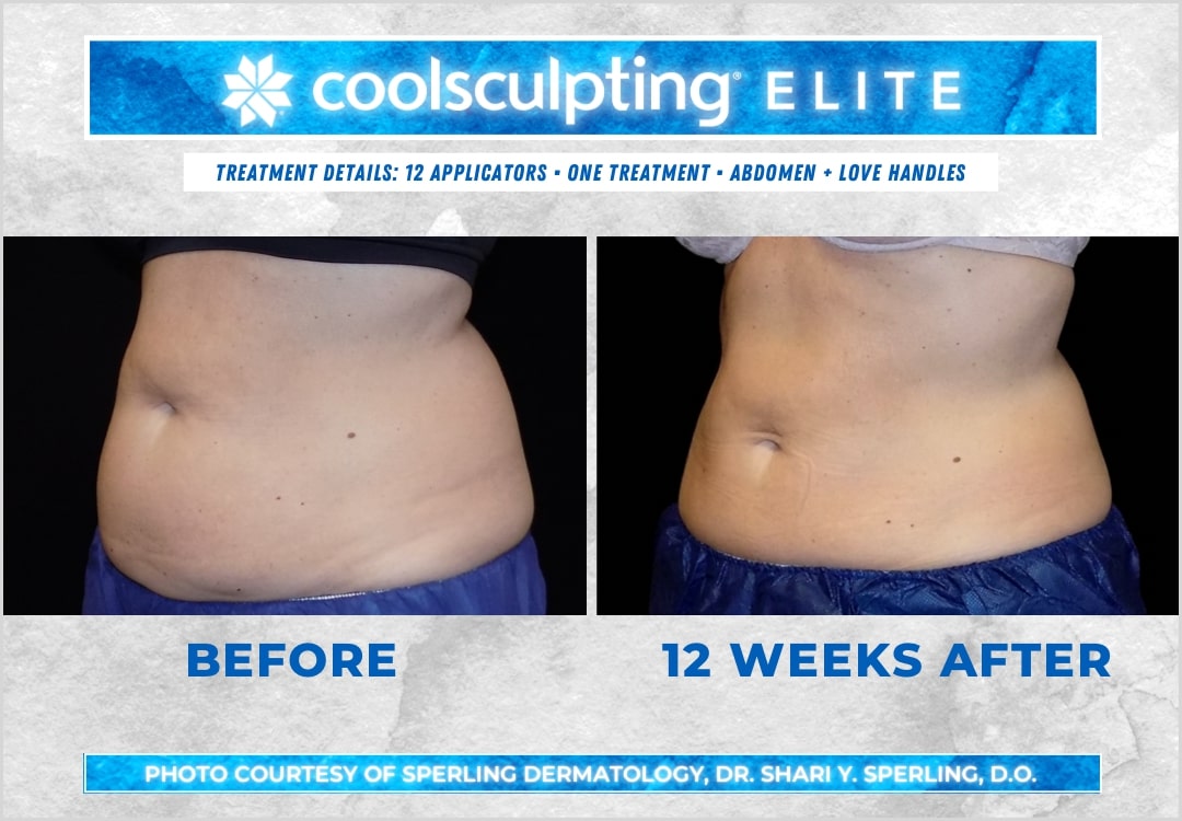 Before & After Abdomen CoolSculpting in New Jersey