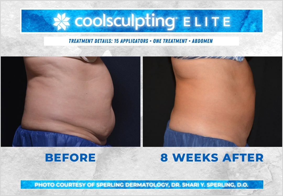 Before & After Abdomen CoolSculpting in New Jersey