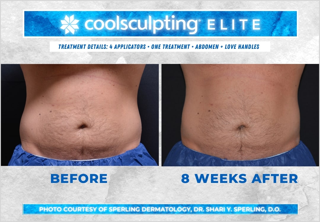 Before & After Abdomen CoolSculpting in New Jersey