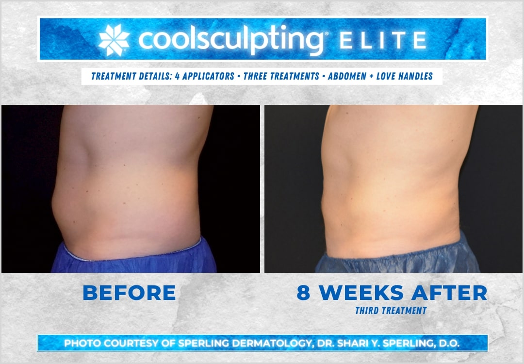 Before & After Abdomen CoolSculpting in New Jersey