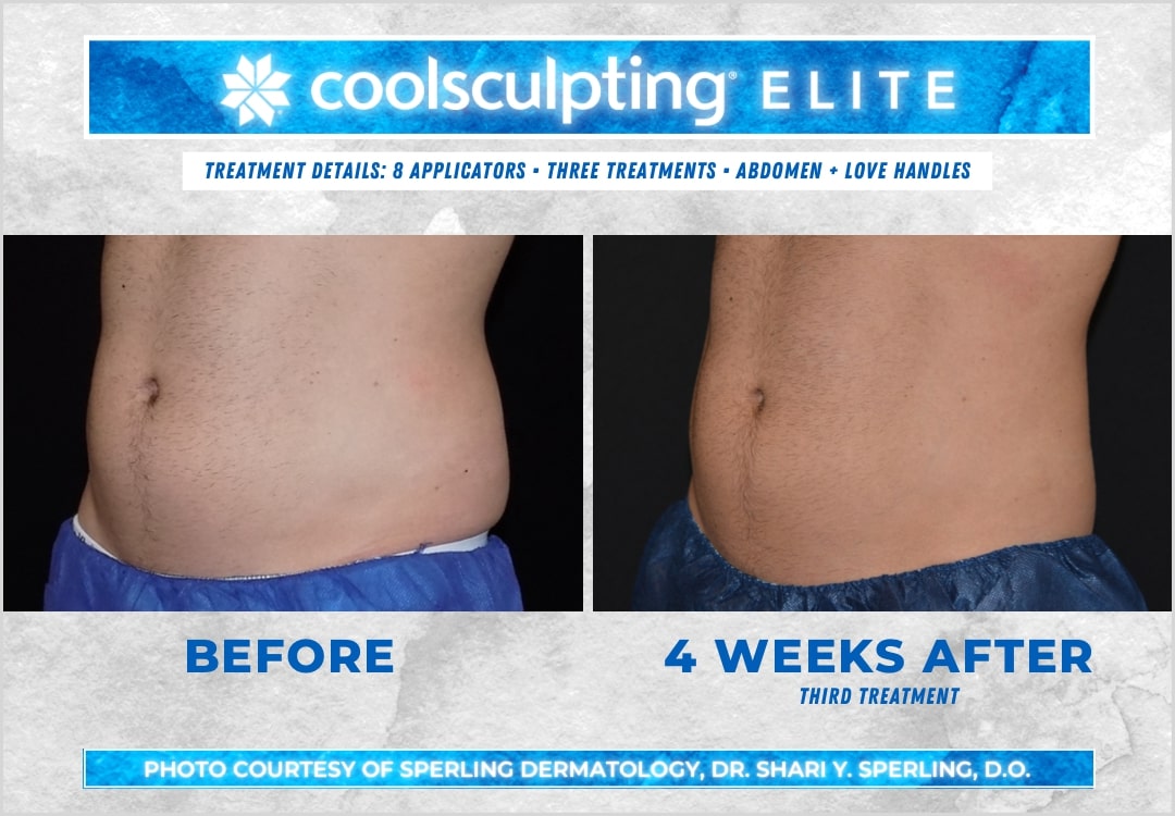 Before & After Abdomen CoolSculpting in New Jersey