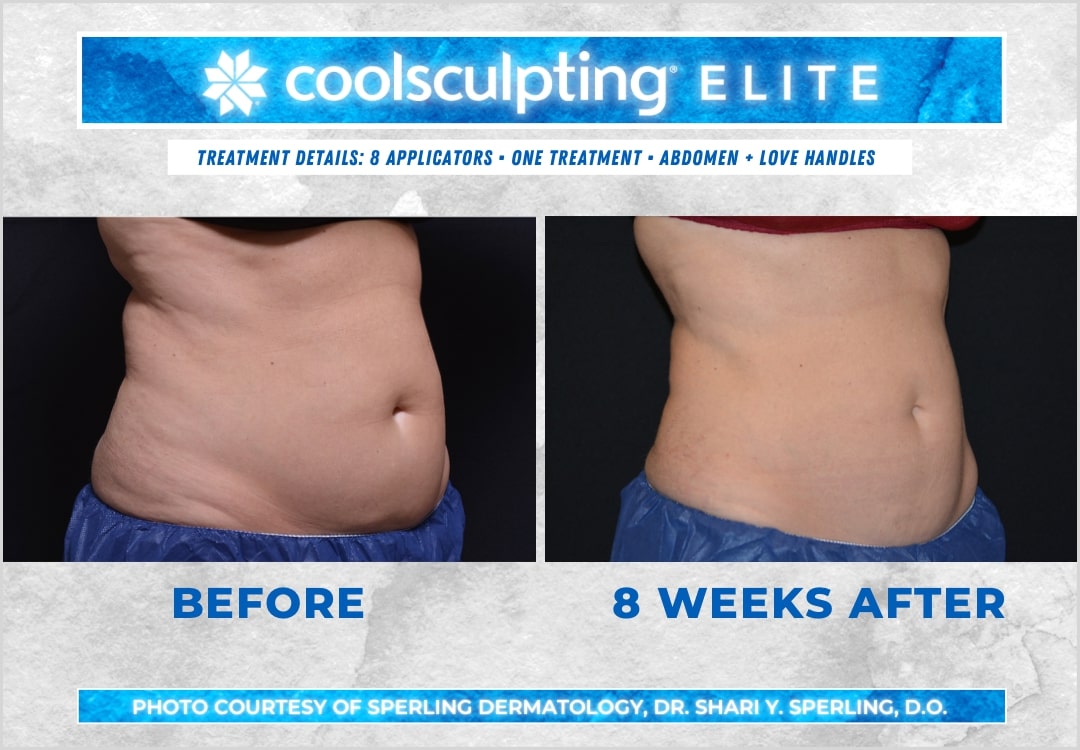 Before & After Abdomen CoolSculpting in New Jersey