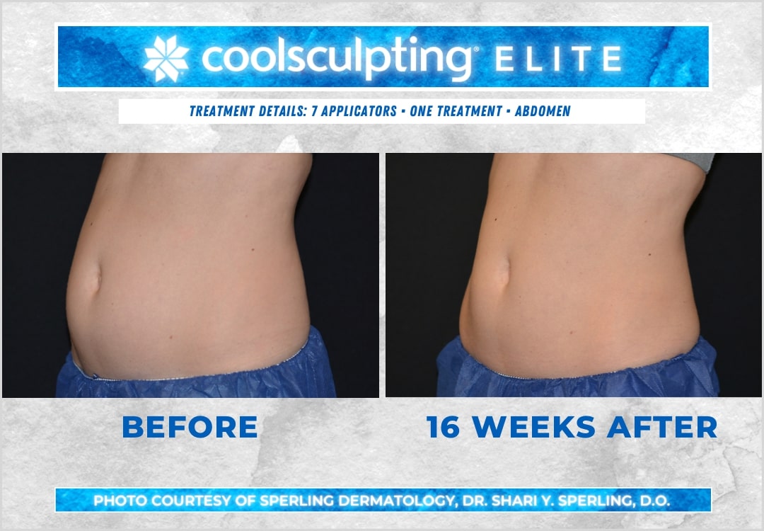 Before & After Abdomen CoolSculpting in New Jersey