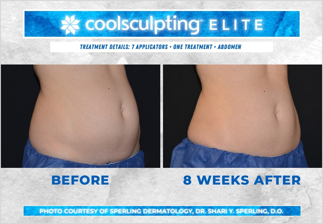 Before & After Abdomen CoolSculpting in New Jersey