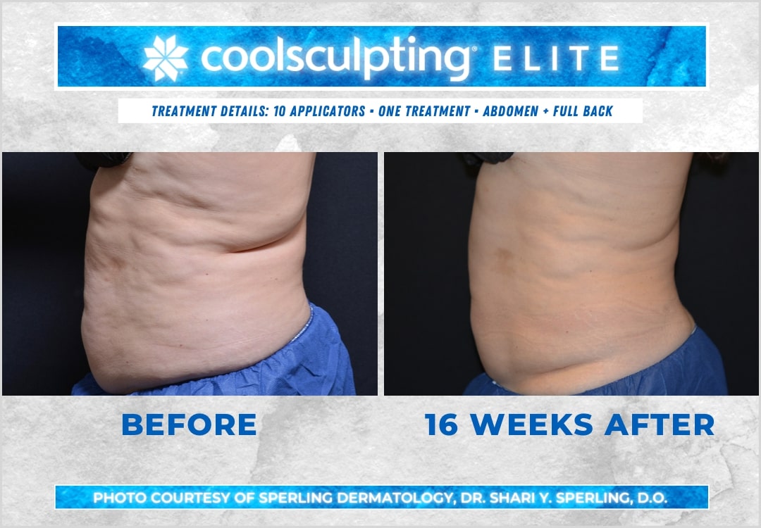 Before & After Abdomen CoolSculpting in New Jersey