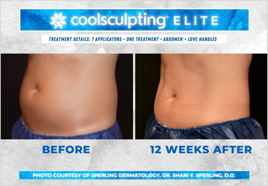 Before & After Abdomen CoolSculpting in New Jersey