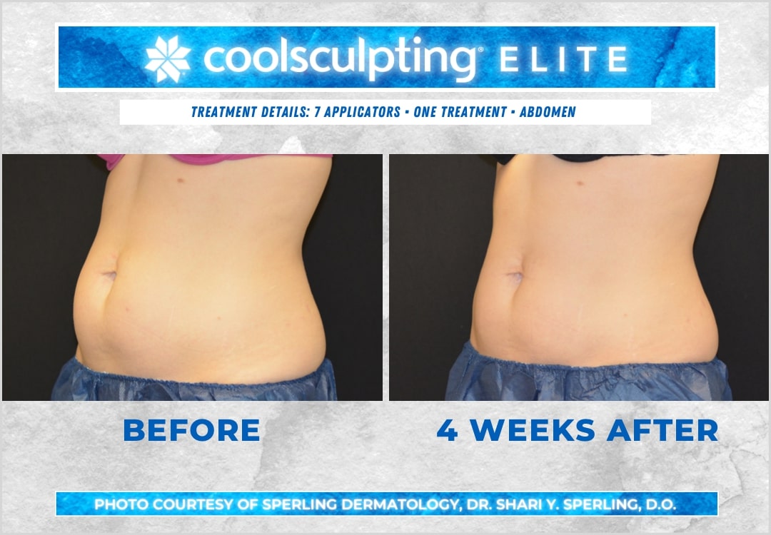 Before & After Abdomen CoolSculpting in New Jersey