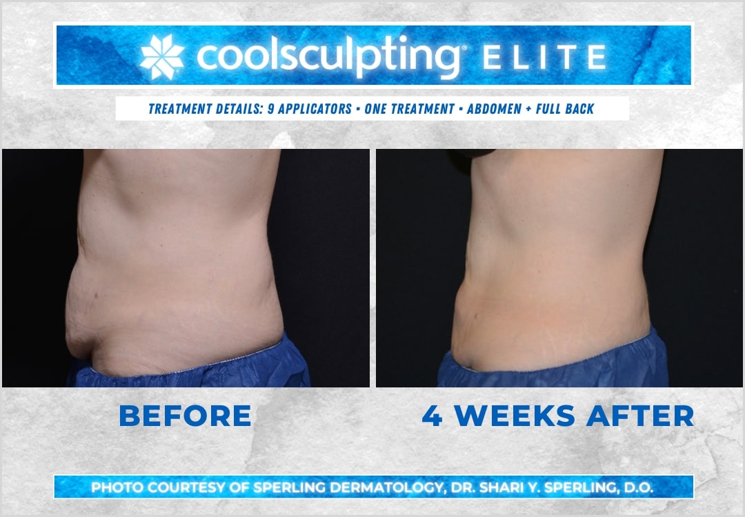 Before & After Abdomen CoolSculpting in New Jersey