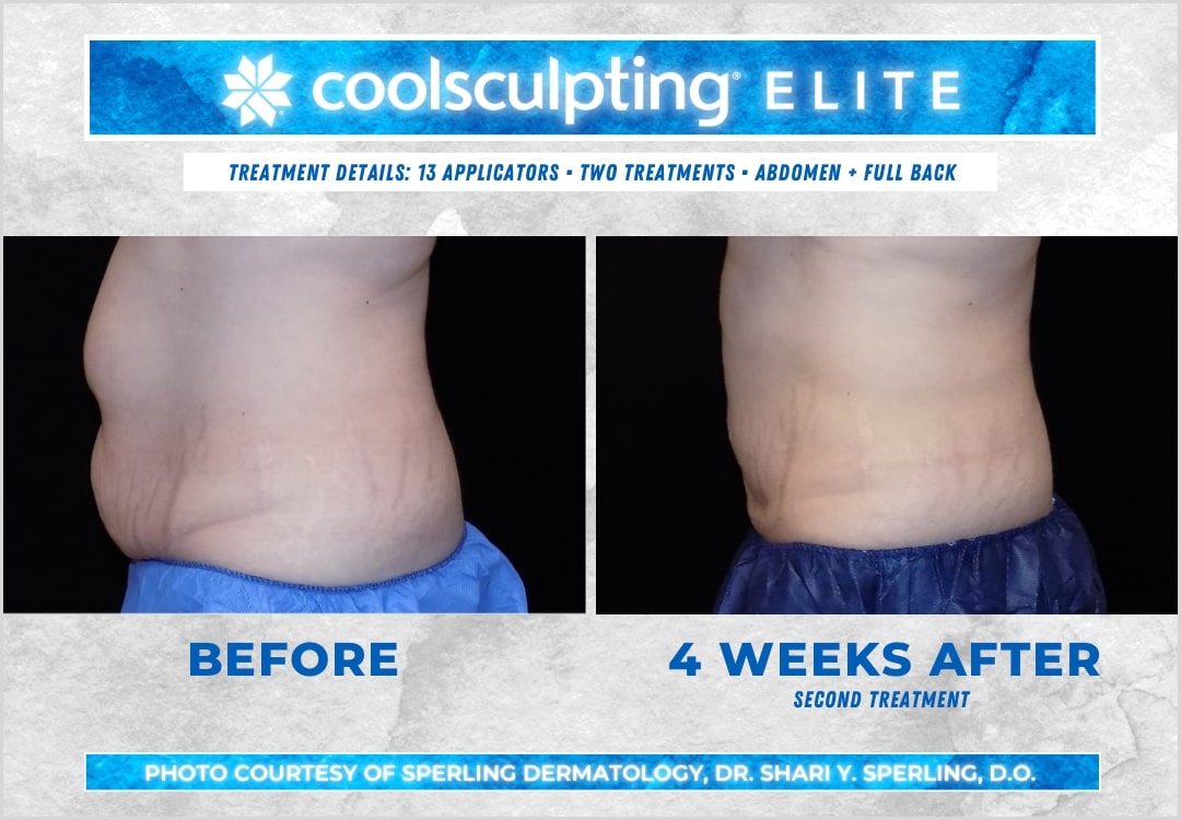 Before & After Abdomen CoolSculpting in New Jersey