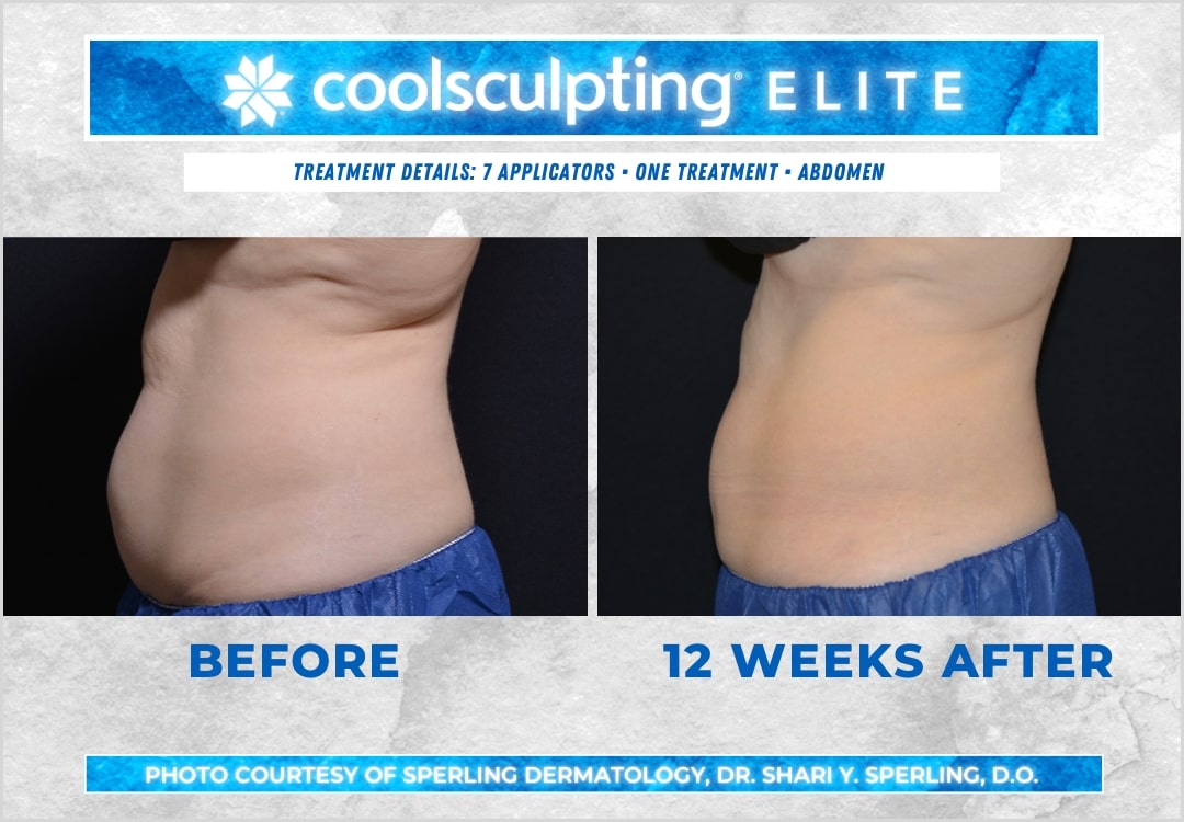 Before & After Abdomen CoolSculpting in New Jersey