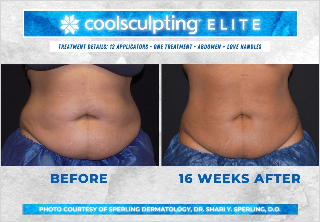 Before & After Abdomen CoolSculpting in New Jersey