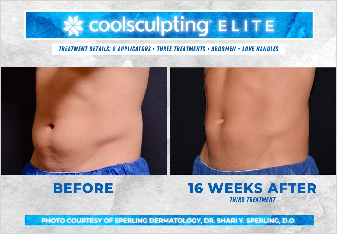 CoolSculpting Before and After 75