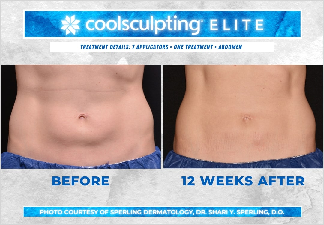 Before & After Abdomen CoolSculpting in New Jersey