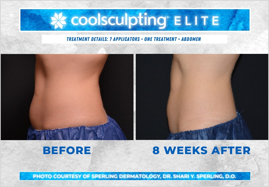 Before & After Abdomen CoolSculpting in New Jersey