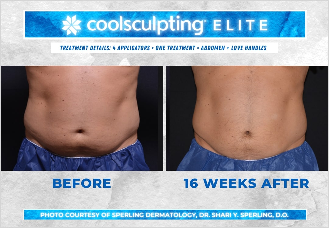 Before & After Abdomen CoolSculpting in New Jersey