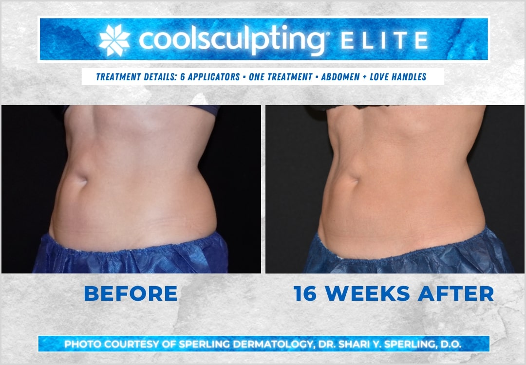 Before & After Abdomen CoolSculpting in New Jersey