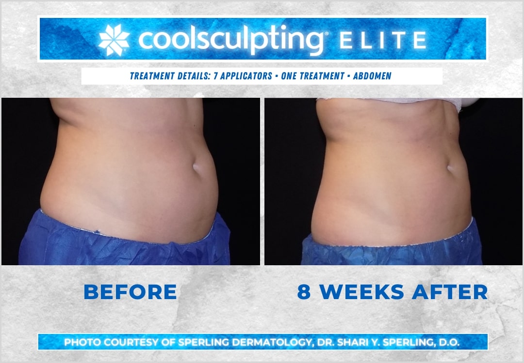 Before & After Abdomen CoolSculpting in New Jersey