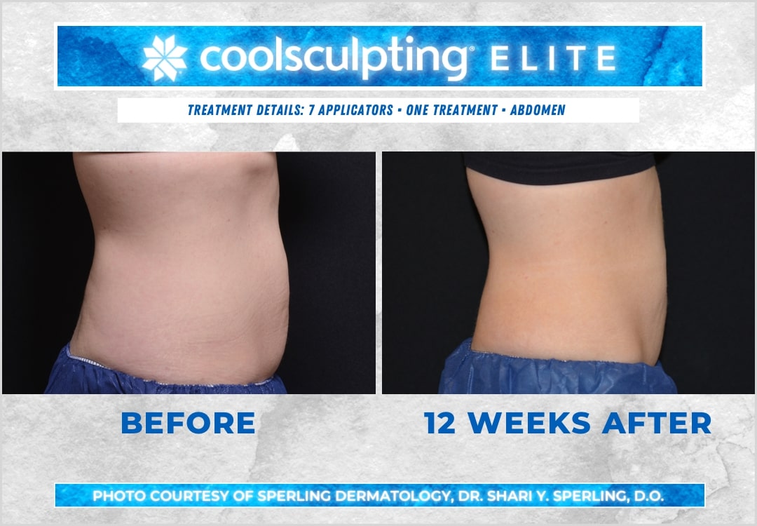 Before & After Abdomen CoolSculpting in New Jersey