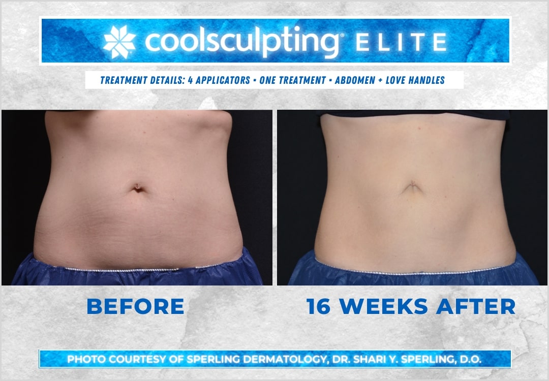 Before & After Abdomen CoolSculpting in New Jersey