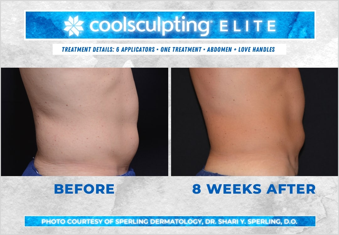 Before & After Abdomen CoolSculpting in New Jersey