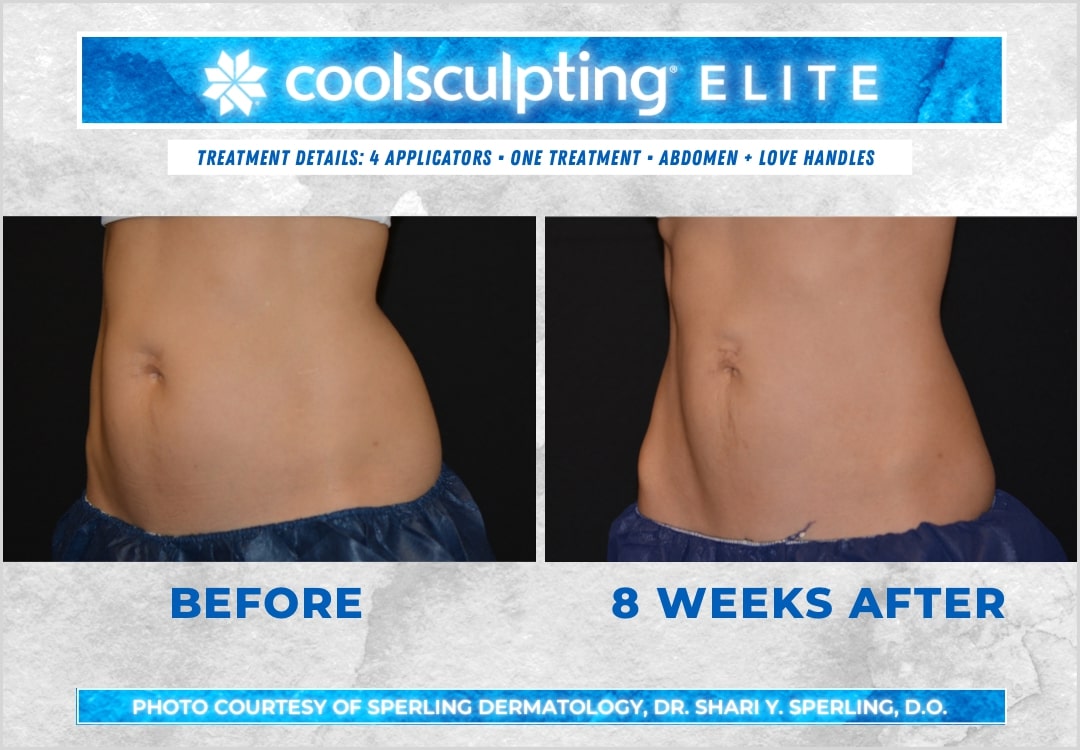 Coolsculpting treatment Before & After photos at 8 West Clinic