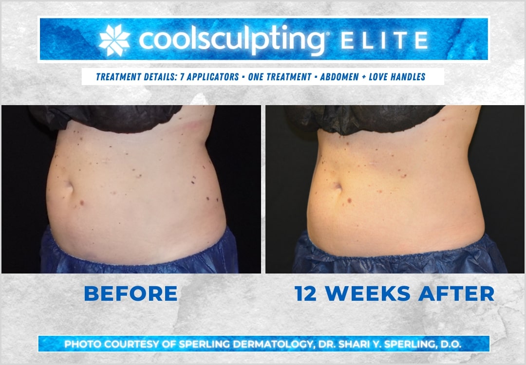 Before & After Abdomen CoolSculpting in New Jersey