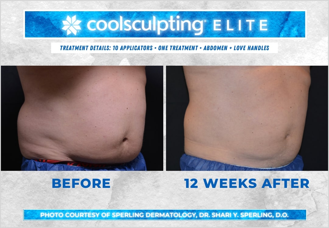 Before & After Abdomen CoolSculpting in New Jersey