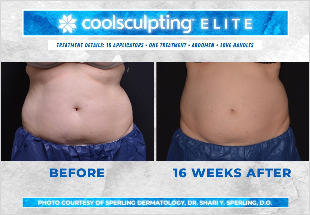 Before & After Abdomen CoolSculpting in New Jersey