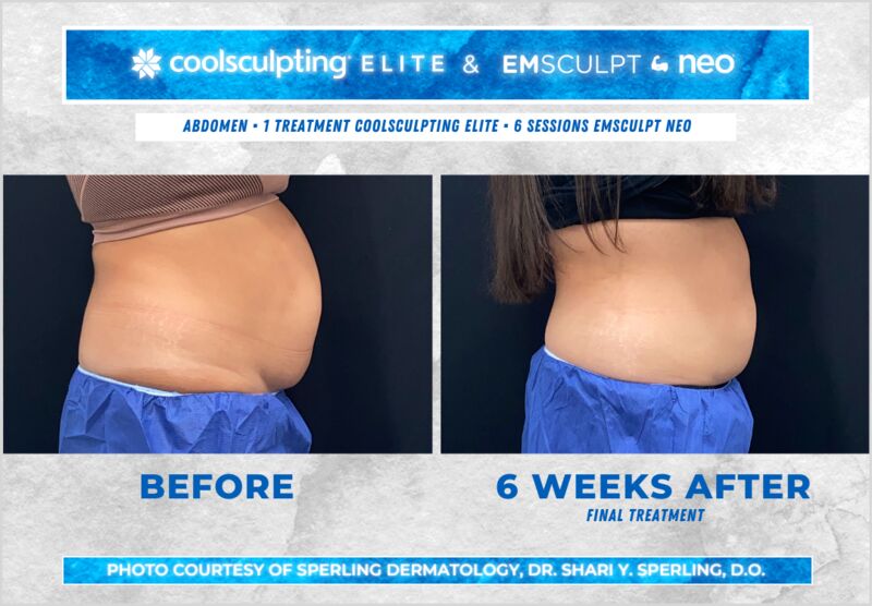 Before & After Abdomen CoolSculpting in New Jersey