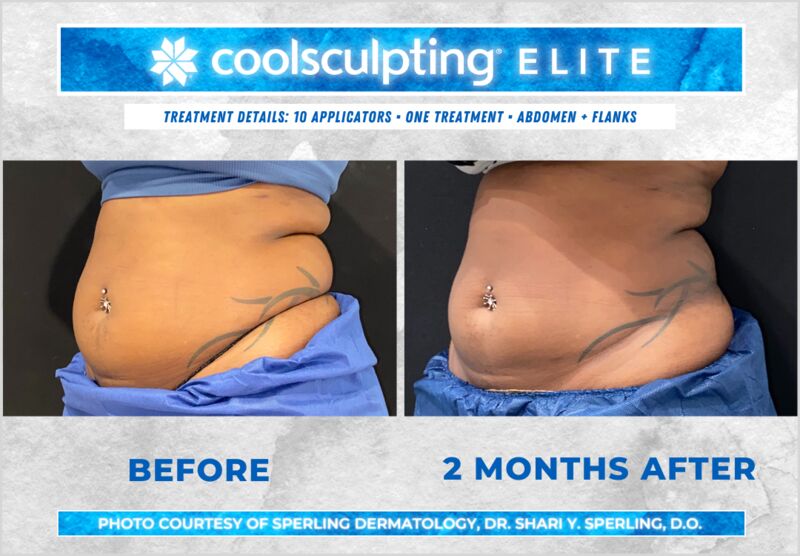 Before & After Abdomen CoolSculpting in New Jersey