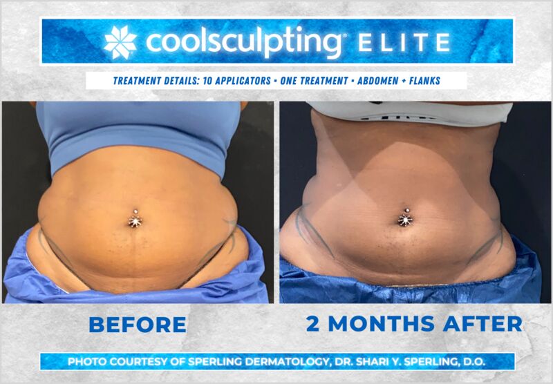 Before & After Abdomen CoolSculpting in New Jersey