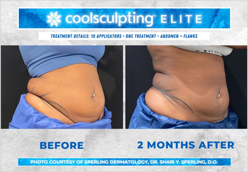 Before & After Abdomen CoolSculpting in New Jersey