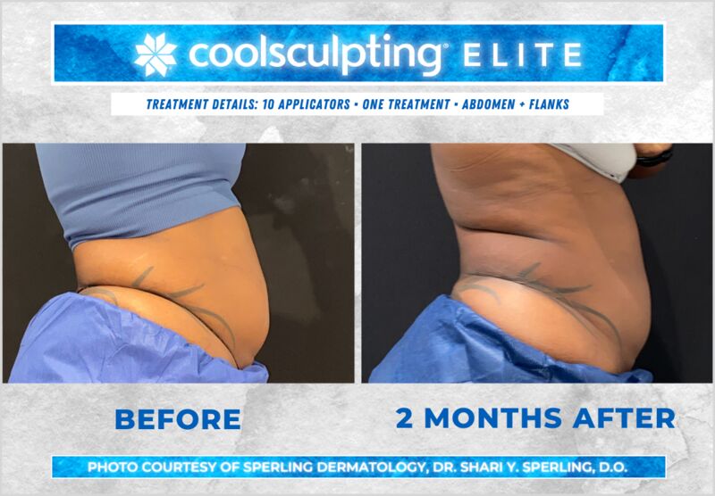 Before & After Abdomen CoolSculpting in New Jersey