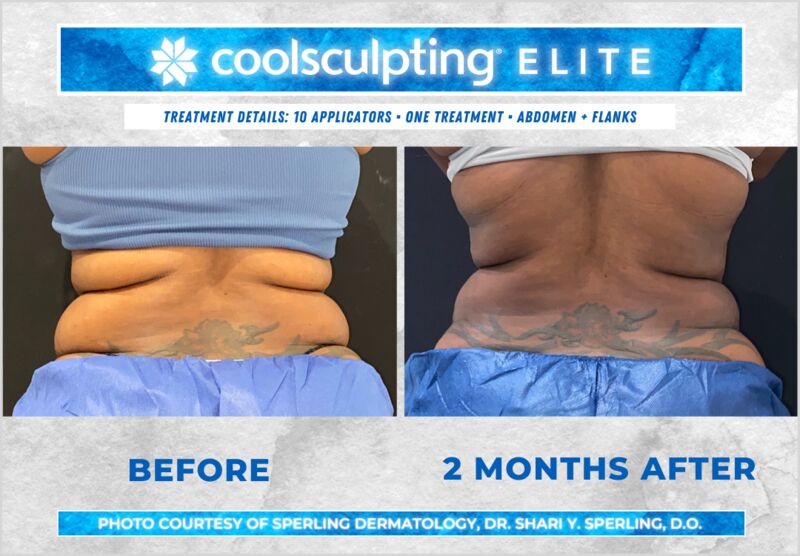 Before & After Abdomen CoolSculpting in New Jersey