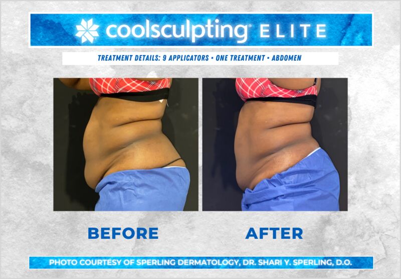 Before & After Abdomen CoolSculpting in New Jersey