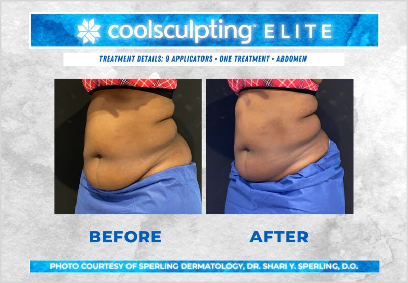 Before & After Abdomen CoolSculpting in New Jersey