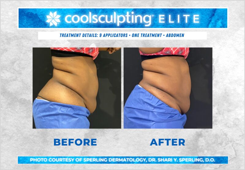 Before & After Abdomen CoolSculpting in New Jersey